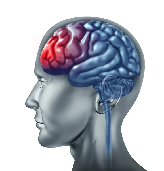 Mozek rozbolela hlava migrain — Stock fotografie
