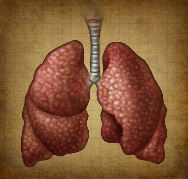 不潔な人間の肺 — ストック写真