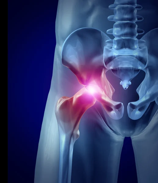 csípő fájdalom hazudik az osteoarthritis tünete és kezelése