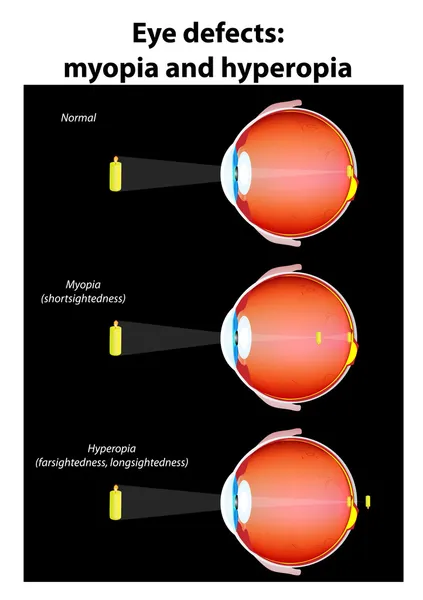 Defeitos oculares: miopia e hipermetropia — Vetor de Stock