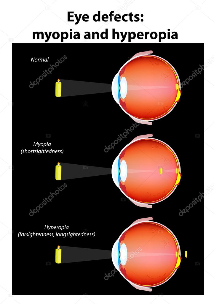 Myopia másképp, Mi a myopia és a hyperopia? Hogyan lehet helyreállítani a látást