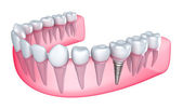 Zahnimplantat im Zahnfleisch - isoliert auf weiß