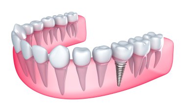 Dental implant in the gum - Isolated on white clipart