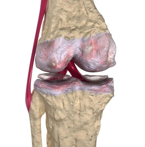 Osteoartritis: articulación de rodilla con ligamentos y cartílagos — Foto de Stock