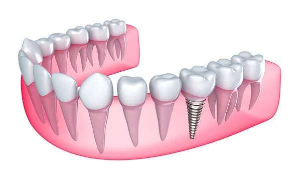 Implants dentaires dans la gencive - Isolé sur blanc Images De Stock Libres De Droits