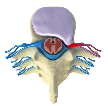 Prolapse of intervertebral disc. Top view clipart