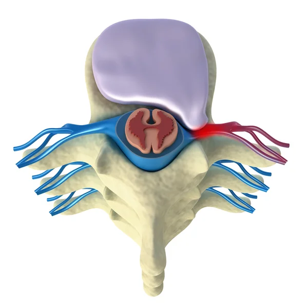 Intervertebral disk prolapsusu. Üstten Görünüm — Stok fotoğraf