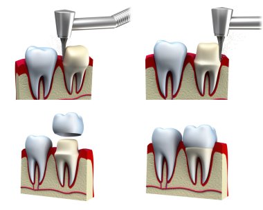 Dental crown installation process, isolated on white clipart