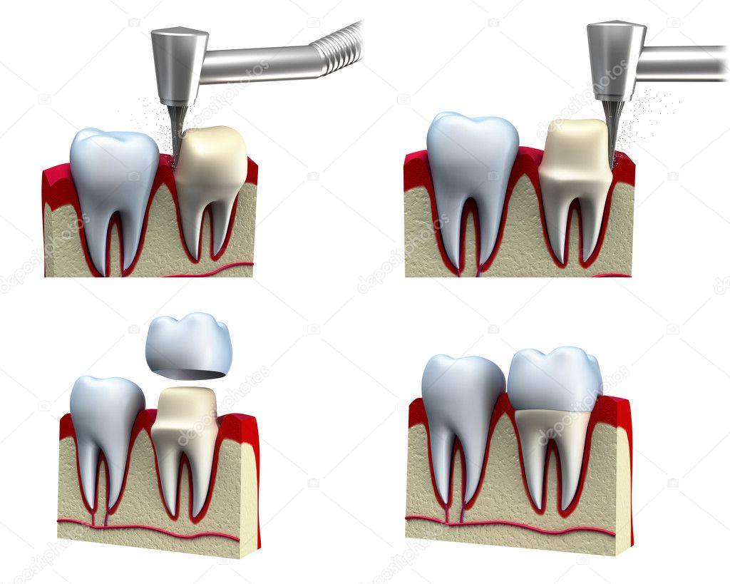 Dental crown installation process, isolated on white