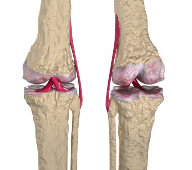 Osteoarthritis : Knee joint with ligaments and cartilages clipart