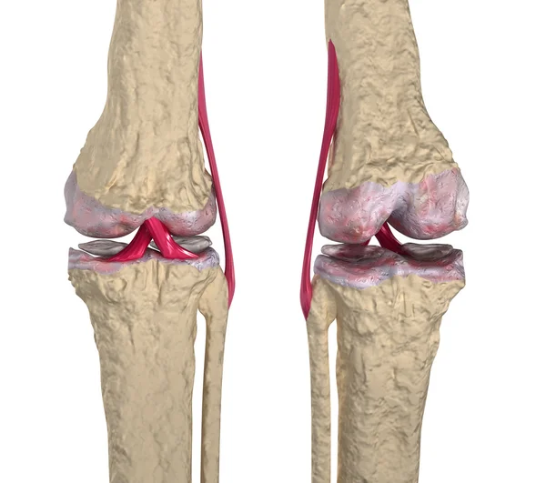 Osteoartrite: Articulação do joelho com ligamentos e cartilagens — Fotografia de Stock
