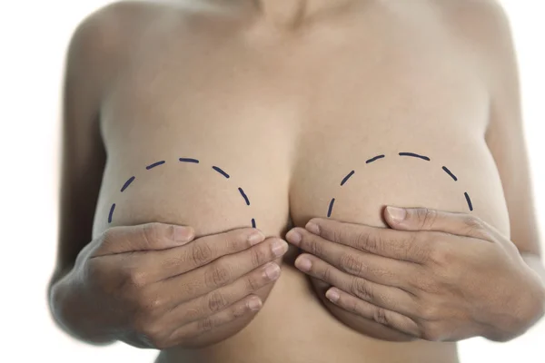 Концепция здоровья: Имплантат груди — стоковое фото
