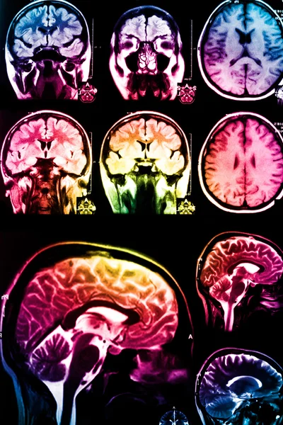Kolorowe x-ray skanowania mózgu — Zdjęcie stockowe