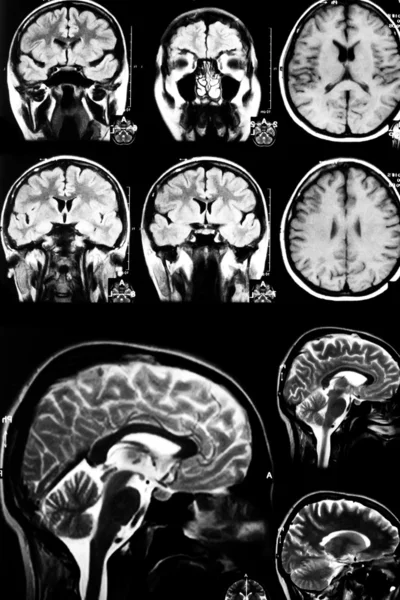 Kolorowe x-ray skanowania mózgu — Zdjęcie stockowe