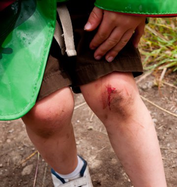 Skinned knee clipart