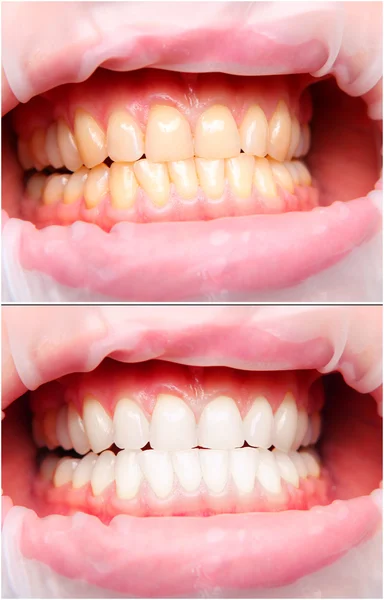 Female teeth — Stock Photo, Image