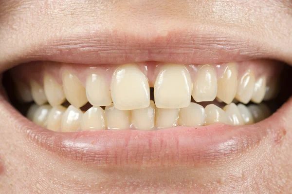 间距的牙齿 — 图库照片