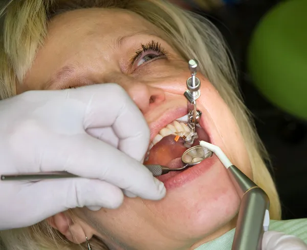 Fare riempimento dentale — Foto Stock