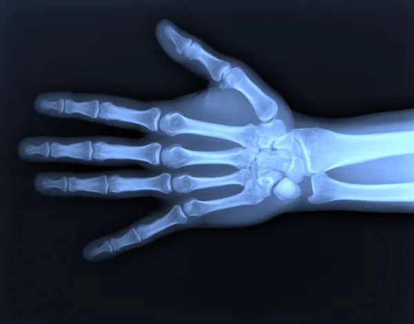 X 射线的手 — 图库照片