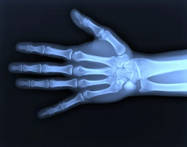 X-ray van hand Stockfoto