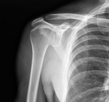 X-ray of shoulder joint clipart
