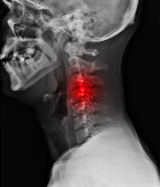 X-ray of painful neck clipart