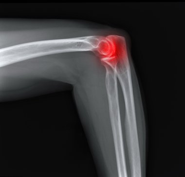 X-ray of the elbow join clipart