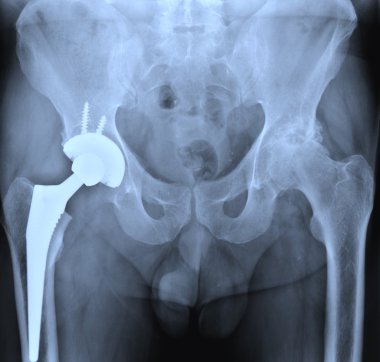 X-ray of the hip prostesis clipart