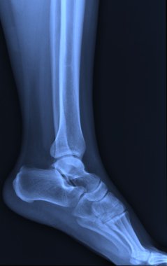 X-ray ankle joint. clipart