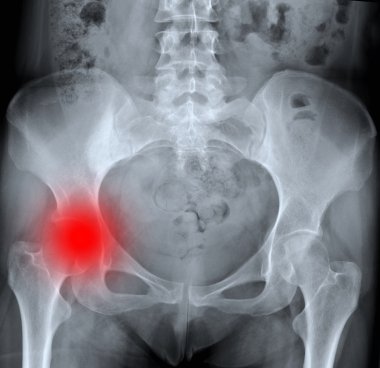 X-ray of painful hip clipart