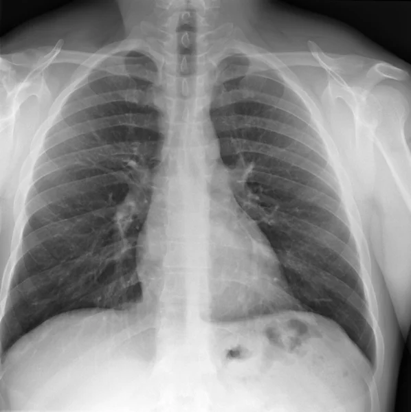 胸部のX線 — ストック写真