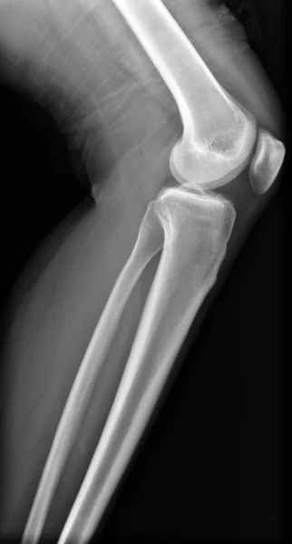 Radiografía de rodilla — Foto de Stock