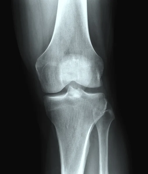Рентгенівська коліно — стокове фото