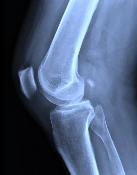 Radiografia del ginocchio — Foto Stock