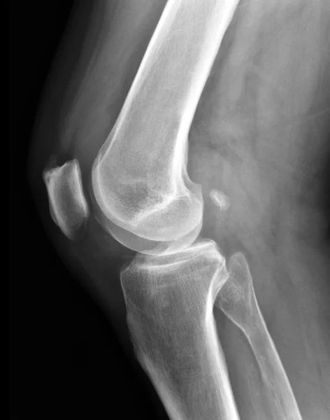 X 射线的膝关节 — 图库照片