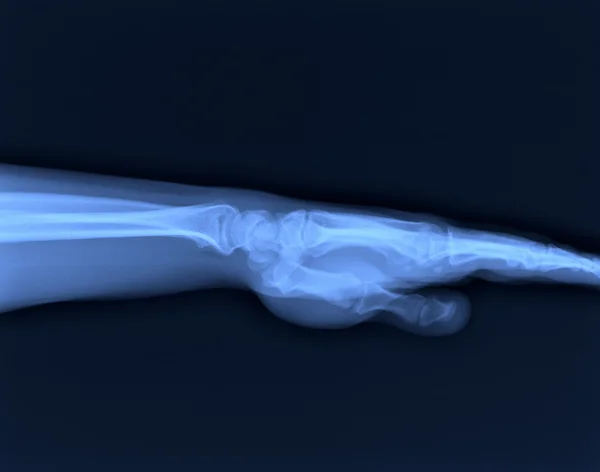 X-ray van hand — Stockfoto