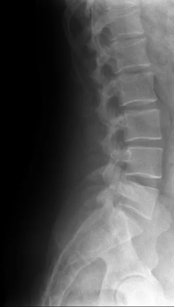 Lumbar spine — Stock Photo, Image