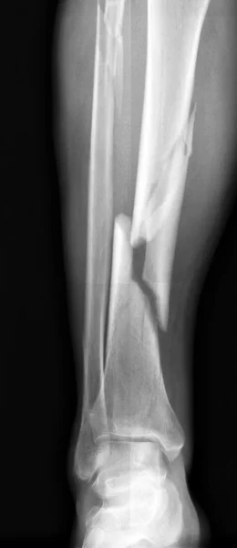 Broken leg — Stock Photo, Image