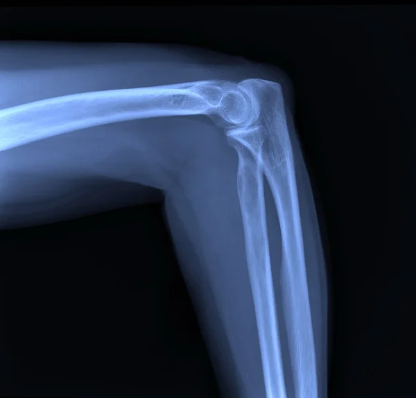 X 射线的手肘联接 — 图库照片