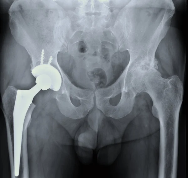 Röntgenbild der Hüftprothese — Stockfoto