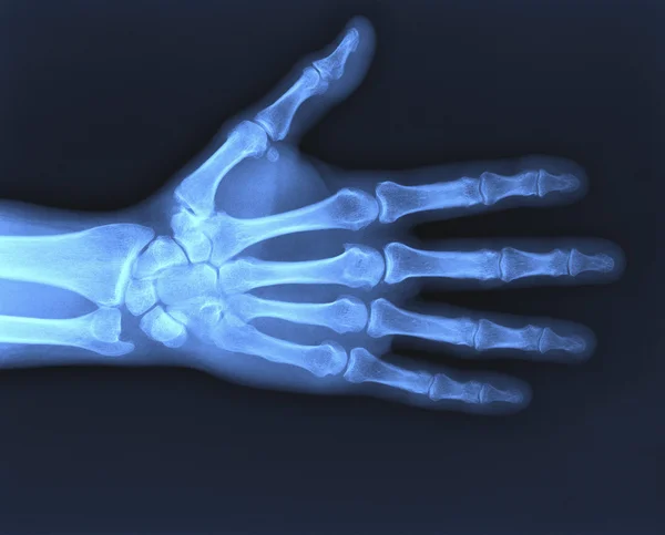 Radiografía de la mano — Foto de Stock