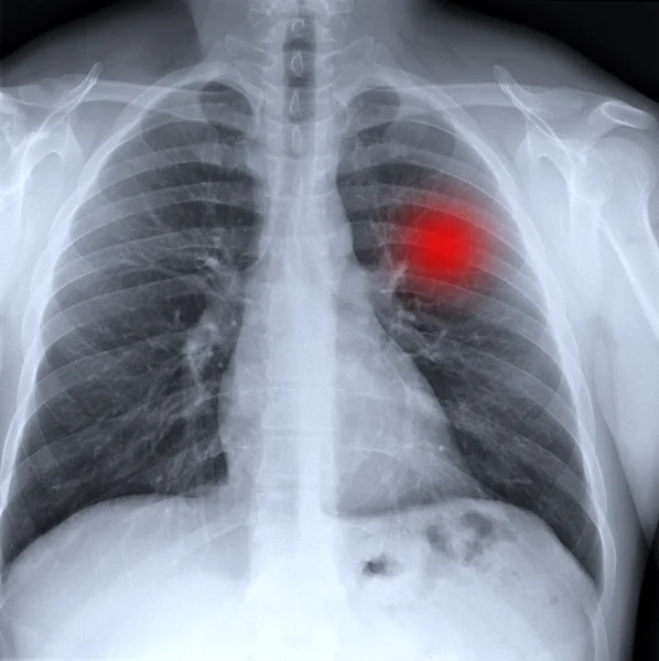Cancer in chest — Stock Photo, Image