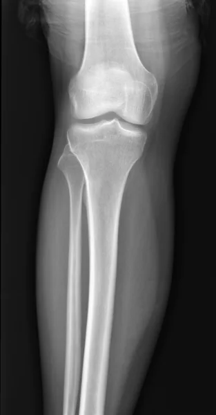 Ακτινογραφία του γόνατος — Φωτογραφία Αρχείου