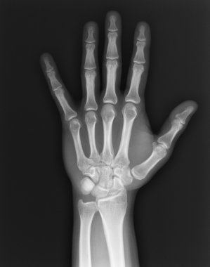 x-ışını eli