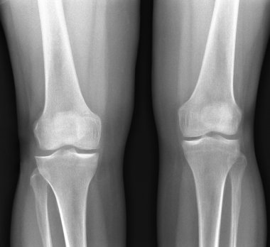X-ray knees clipart