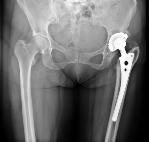 Zdjęcie rentgenowskie endoprotezy biodra — Zdjęcie stockowe