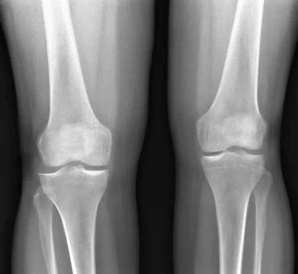 X 선 무릎 — 스톡 사진