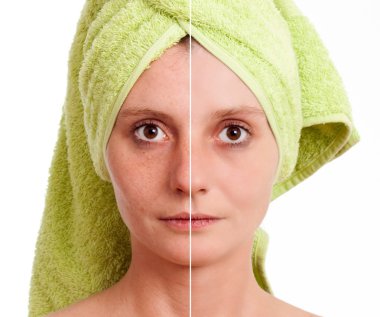 Woman with spotty skin with deep pores and blackhead and healed soft skin - clipart