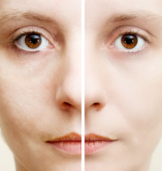 Vrouw met vlekkerige huid met grote poriën en mee-eter en genezen zachte huid — Stockfoto