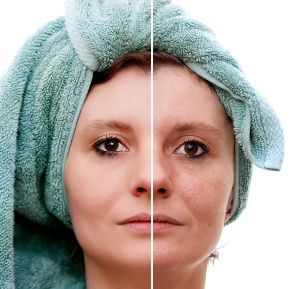 Женщина с пятнистой кожей с глубокими порами и черной головой и зажившей мягкой кожей - до и после — стоковое фото